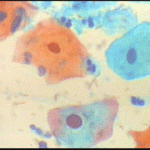Υποτροπές κυτταρολογικών ατυπιών ερπητικής  αιτιολογίας, με συμπτωματολογία  κολπίτιδας